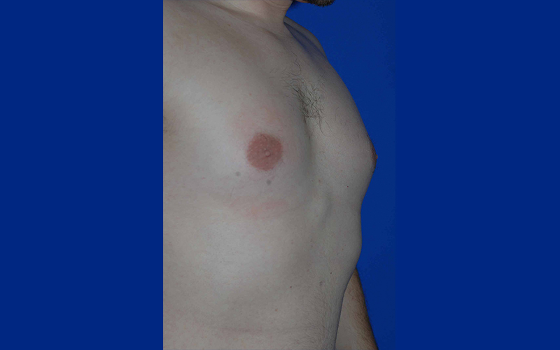 Gynecomastia before photo