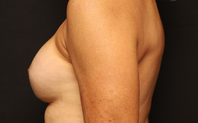 Implant Revision before photo