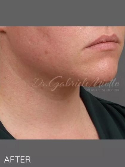 A result from Miotto Plastic Surgery (Dr. Gabriele Miotto)