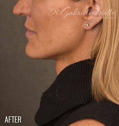 A result from Miotto Plastic Surgery (Dr. Gabriele Miotto)