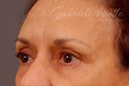 A result from Miotto Plastic Surgery (Dr. Gabriele Miotto)