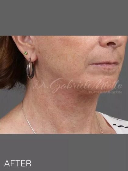 A result from Miotto Plastic Surgery (Dr. Gabriele Miotto)