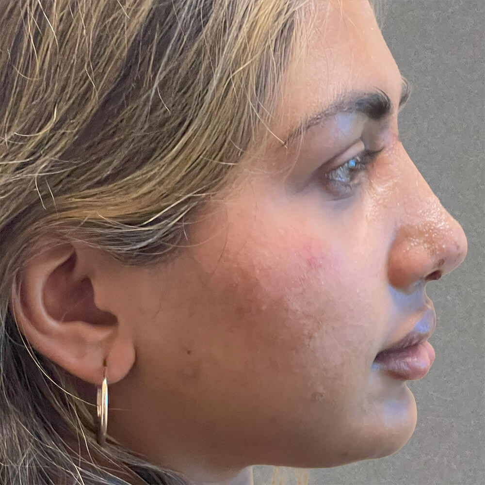 Rhinoplasty result at Dr. David Gerth Plastic Surgery