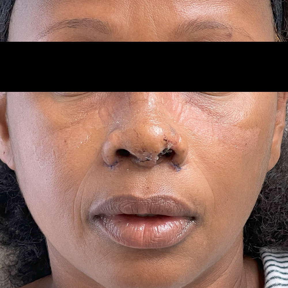 Rhinoplasty result at Dr. David Gerth Plastic Surgery