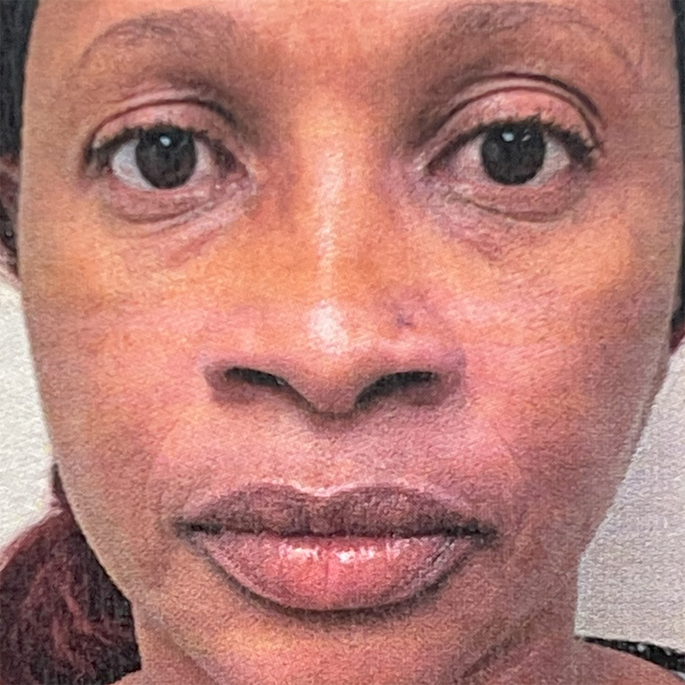 Rhinoplasty before photo