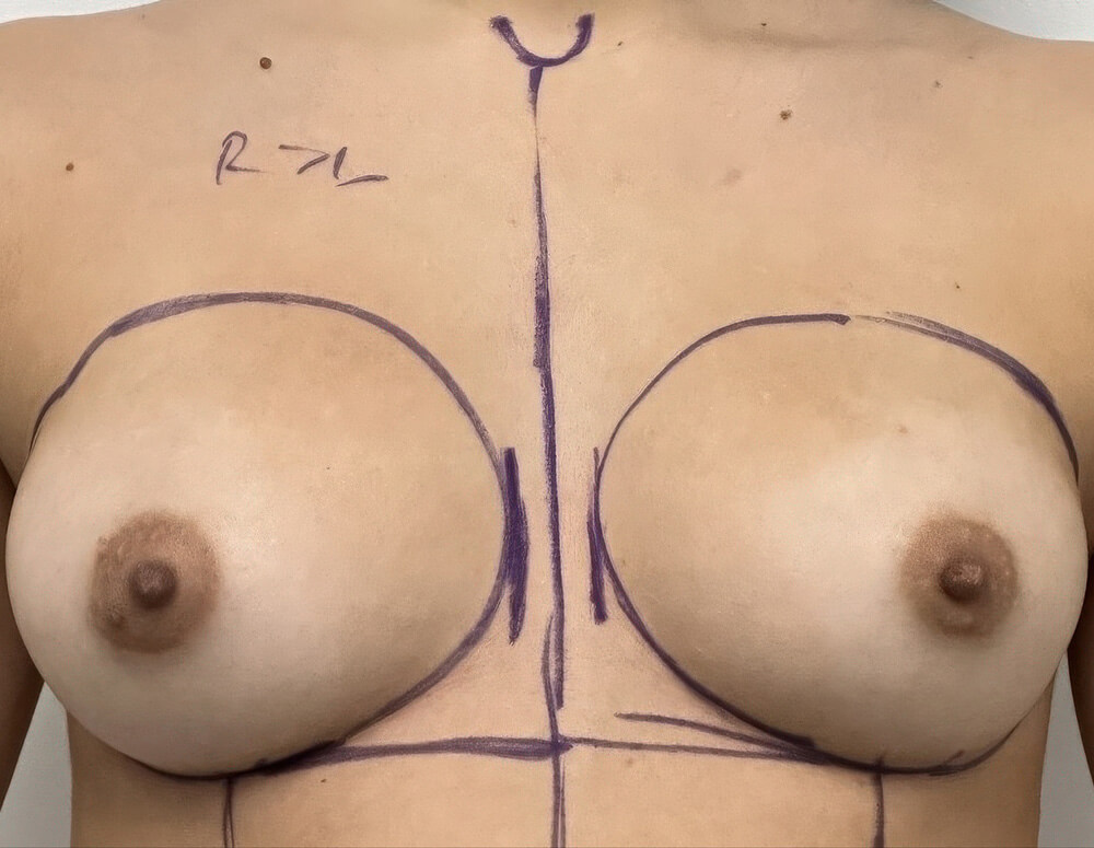 Breast Augmentation before photo