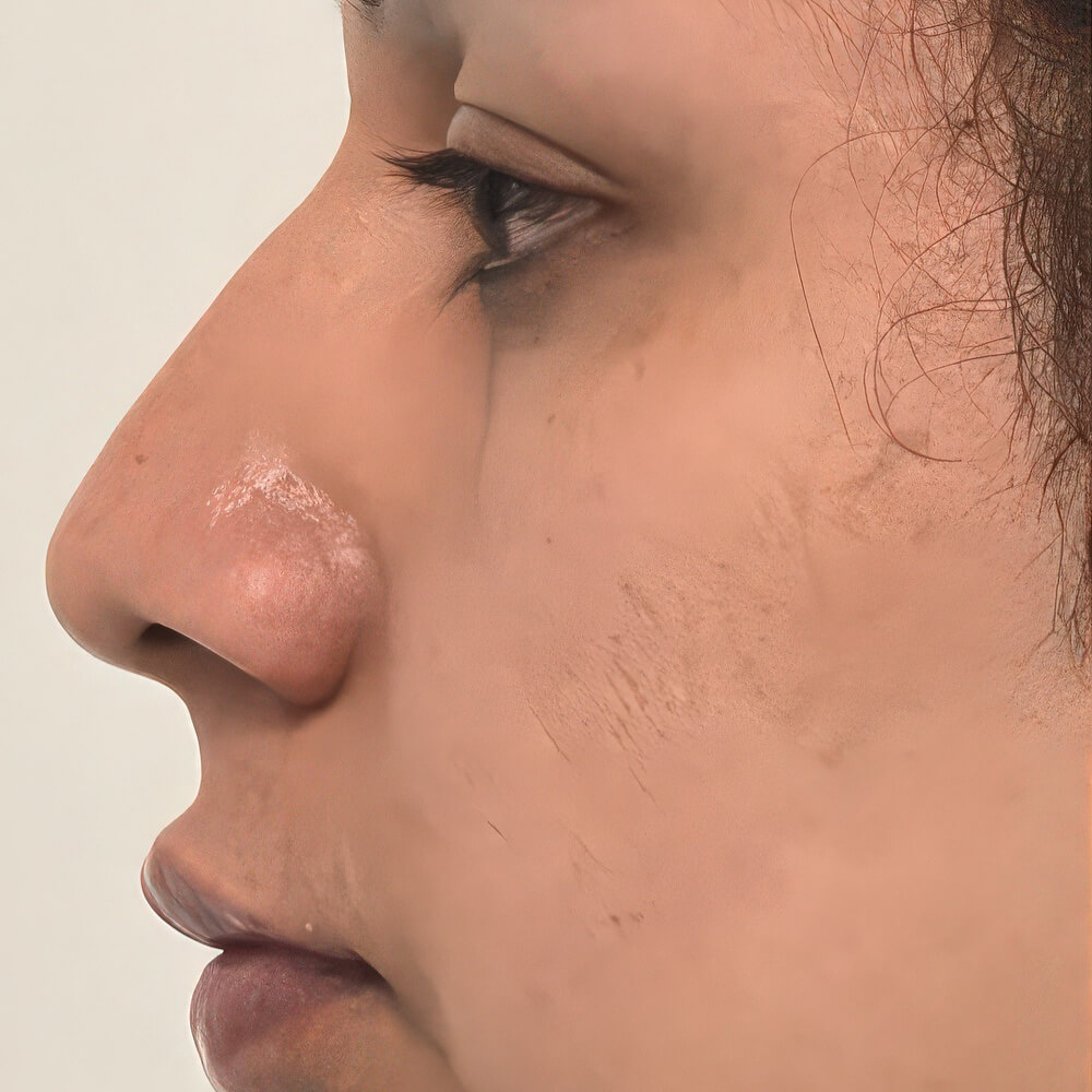 Rhinoplasty before photo