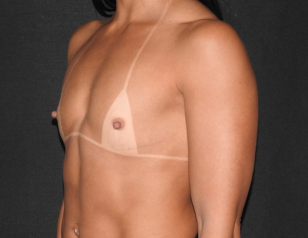 Breast Augmentation before photo