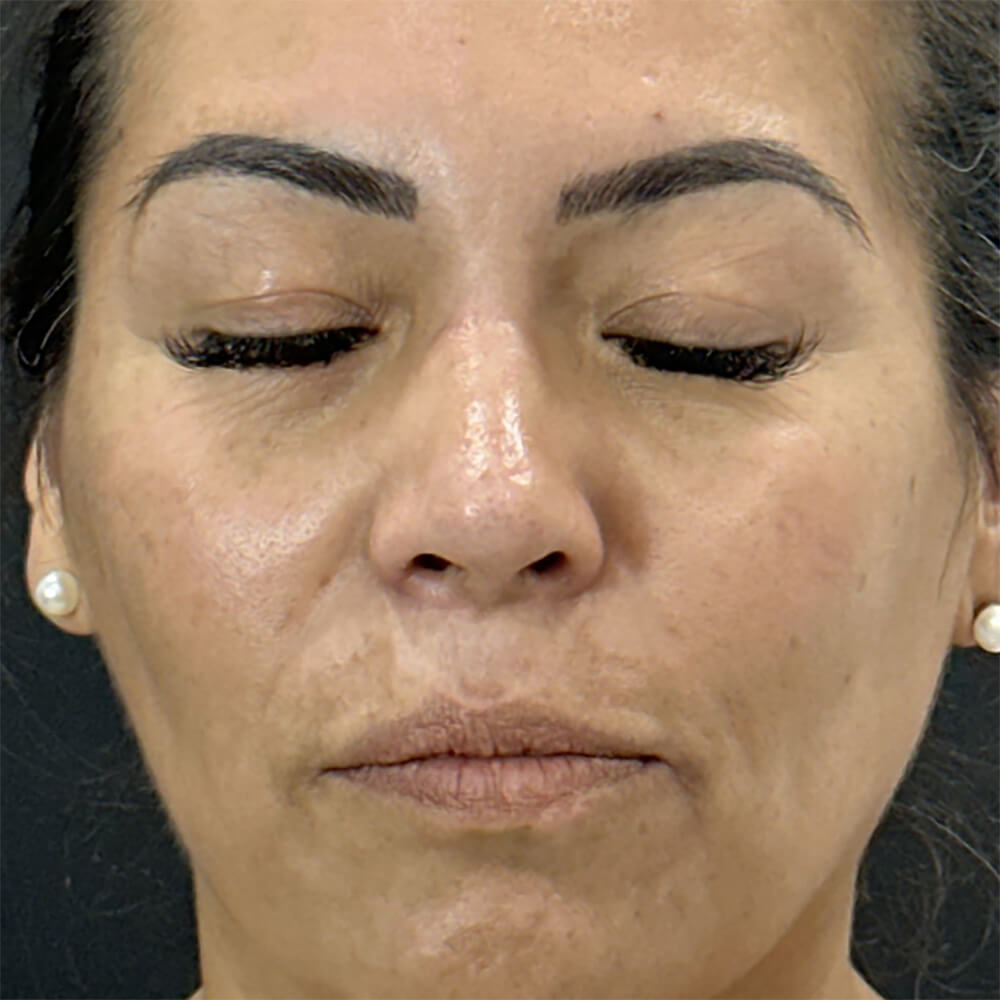Rhinoplasty result at Dr. David Gerth Plastic Surgery