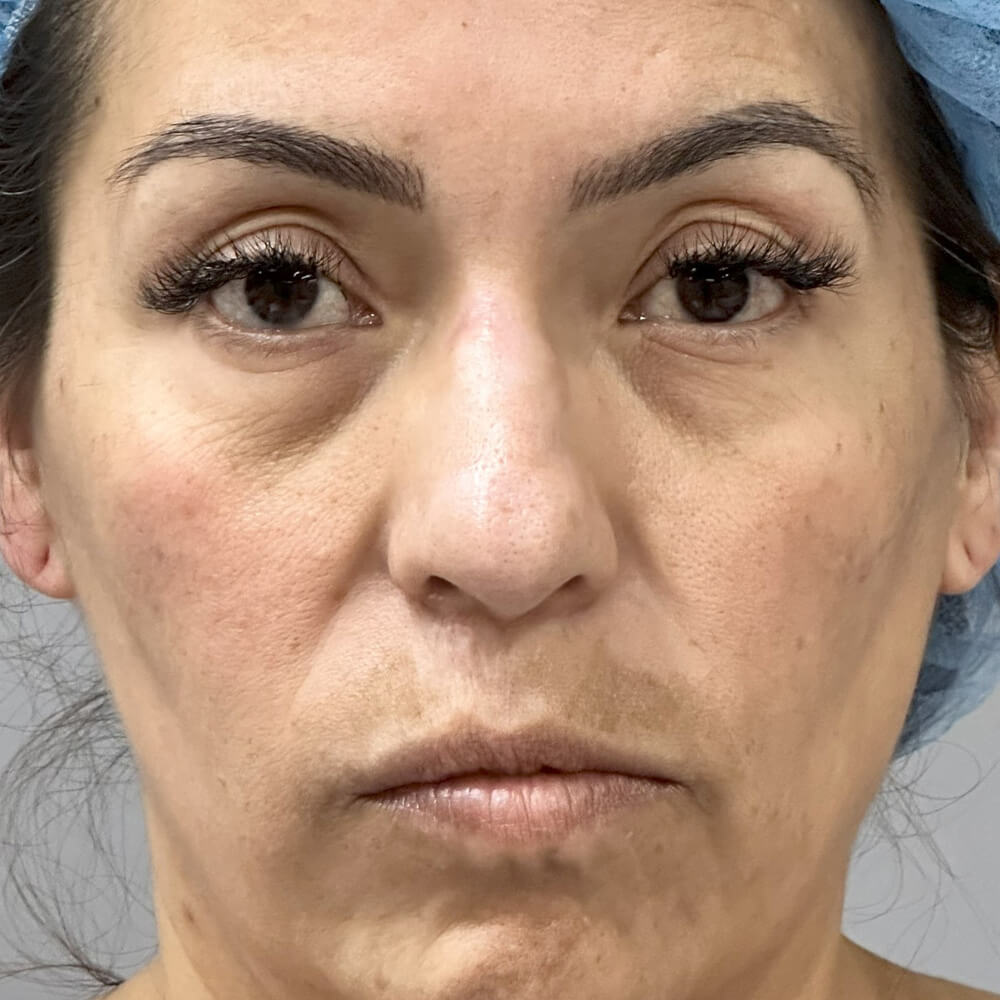 Rhinoplasty before photo