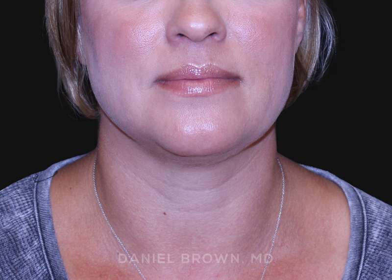 A result from Top Plastic Surgeon San Diego: Dr. Daniel Brown