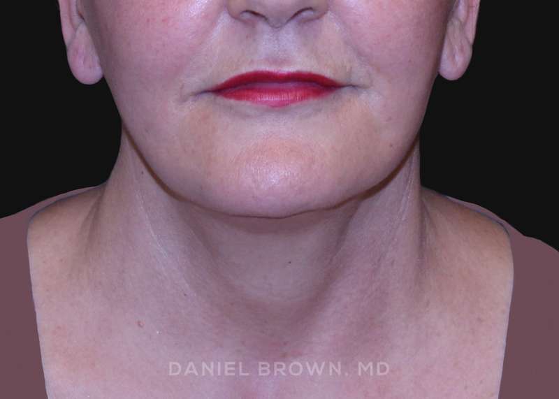 A result from Top Plastic Surgeon San Diego: Dr. Daniel Brown