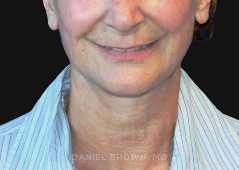 A result from Top Plastic Surgeon San Diego: Dr. Daniel Brown