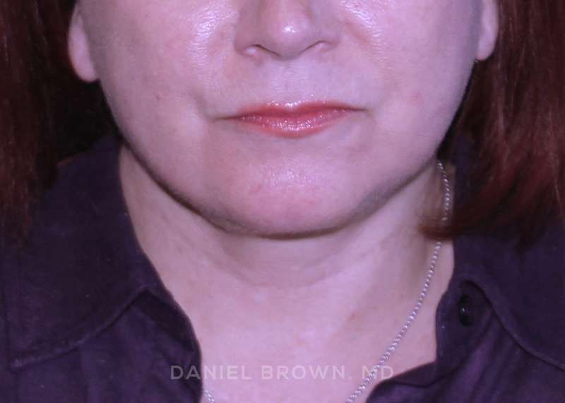 A result from Top Plastic Surgeon San Diego: Dr. Daniel Brown