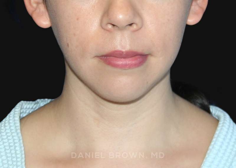 A result from Top Plastic Surgeon San Diego: Dr. Daniel Brown
