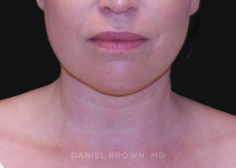 A result from Top Plastic Surgeon San Diego: Dr. Daniel Brown