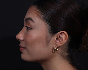 Rhinoplasty result at Cangello Plastic Surgery
