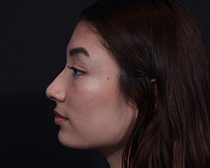 Rhinoplasty before photo