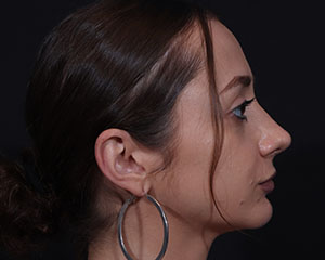 Rhinoplasty result at Cangello Plastic Surgery