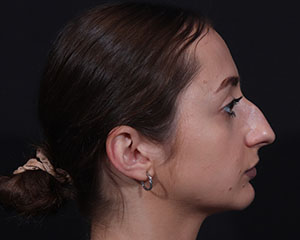 Rhinoplasty before photo