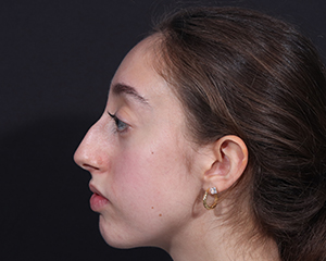 Rhinoplasty before photo