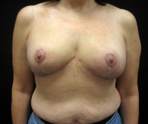 Breast Reduction result at Cangello Plastic Surgery