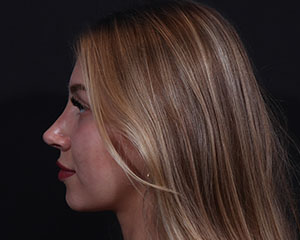 Rhinoplasty result at Cangello Plastic Surgery