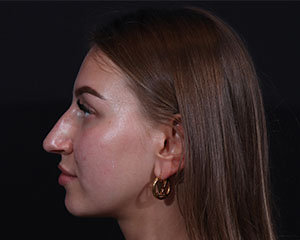 Rhinoplasty before photo