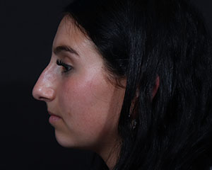 Rhinoplasty before photo
