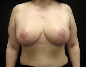 Breast Reduction result at Cangello Plastic Surgery