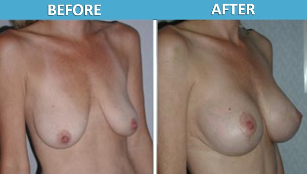 A result from Center for Cosmetic Surgery: Sassan Alavi, MD