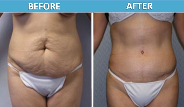 A result from Center for Cosmetic Surgery: Sassan Alavi, MD