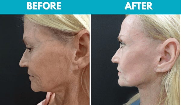 A result from Center for Cosmetic Surgery: Sassan Alavi, MD