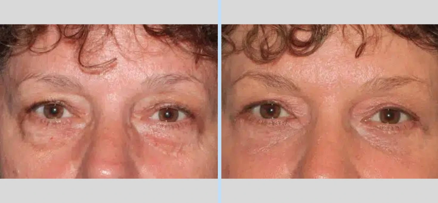 A result from Main Line Plastic Surgery- Raymond Jean MD