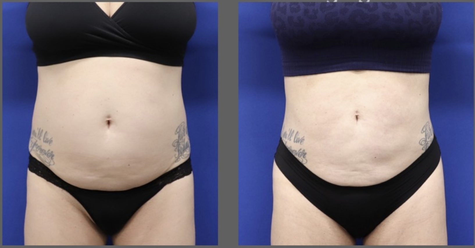 A result from Main Line Plastic Surgery- Raymond Jean MD
