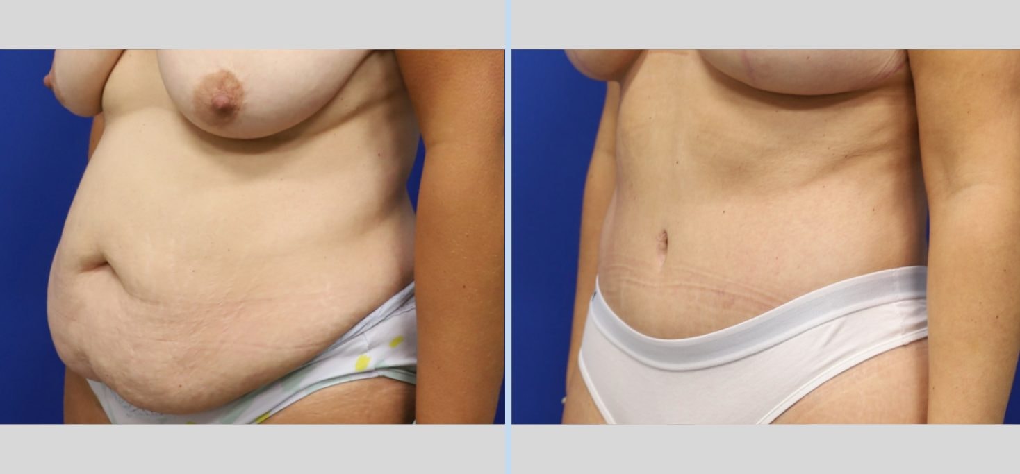 A result from Main Line Plastic Surgery- Raymond Jean MD