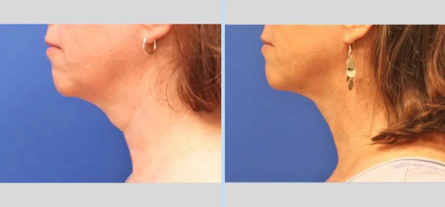 A result from Main Line Plastic Surgery- Raymond Jean MD