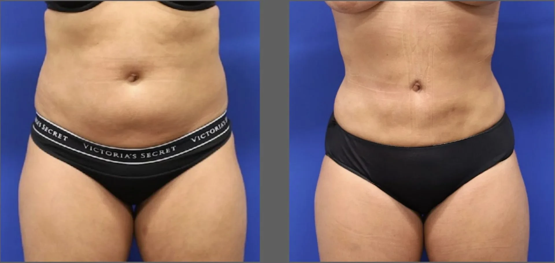 A result from Main Line Plastic Surgery- Raymond Jean MD