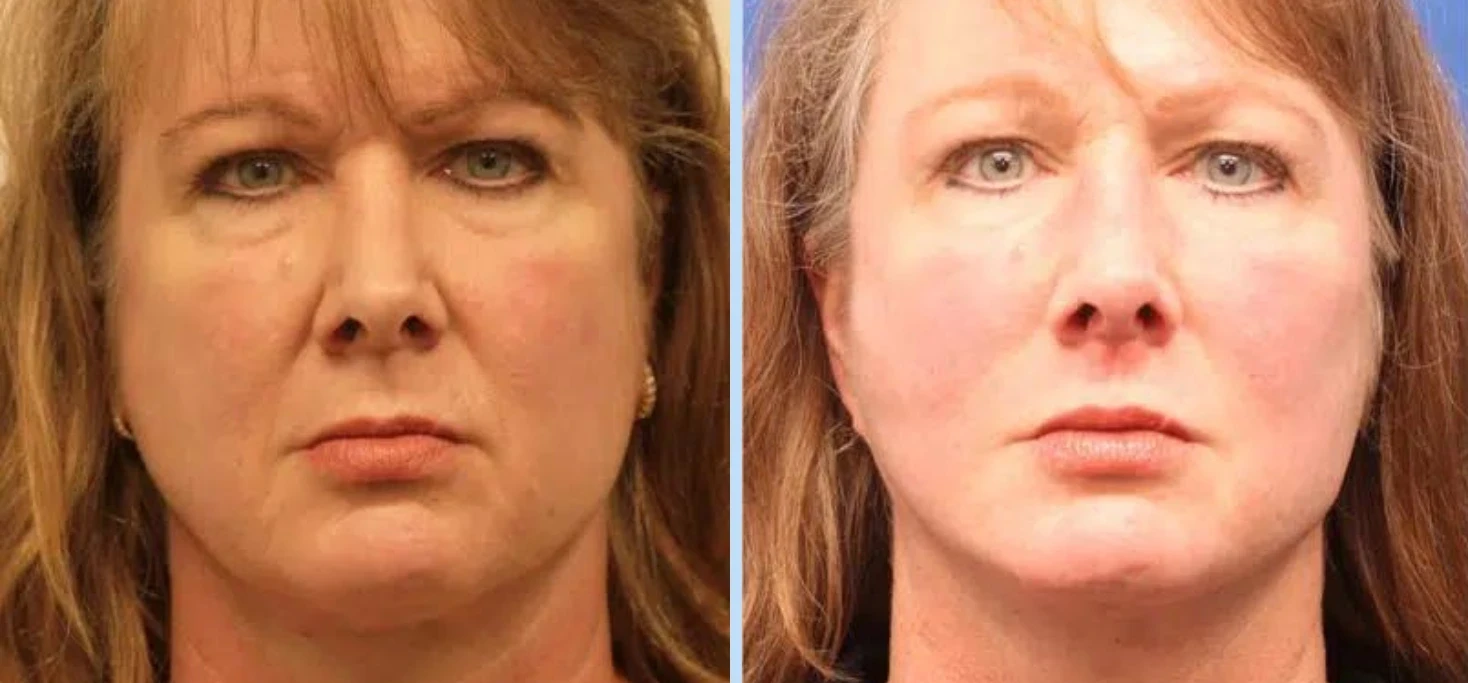 A result from Main Line Plastic Surgery- Raymond Jean MD
