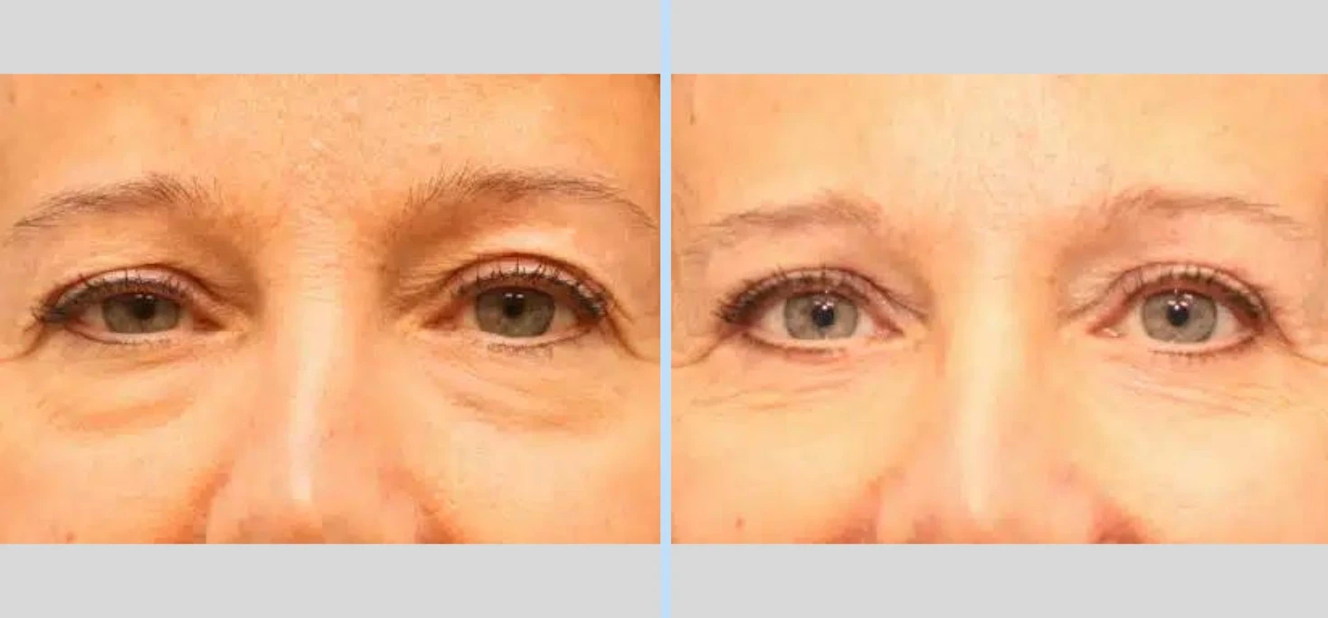 A result from Main Line Plastic Surgery- Raymond Jean MD