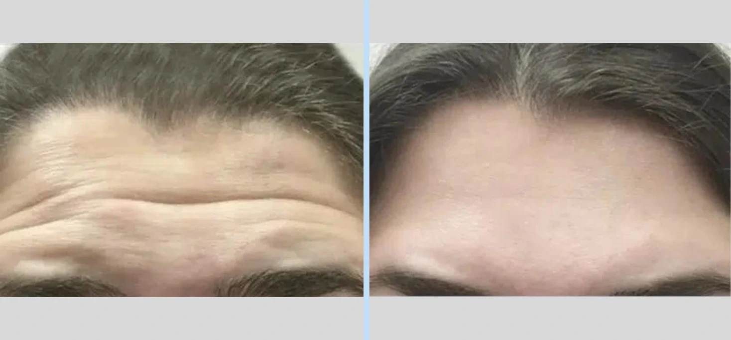 A result from Main Line Plastic Surgery- Raymond Jean MD