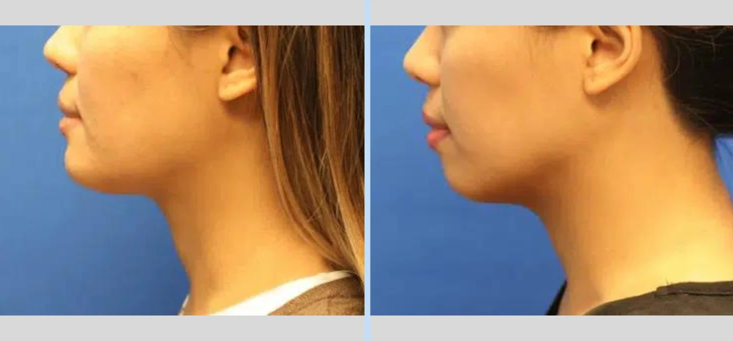 A result from Main Line Plastic Surgery- Raymond Jean MD