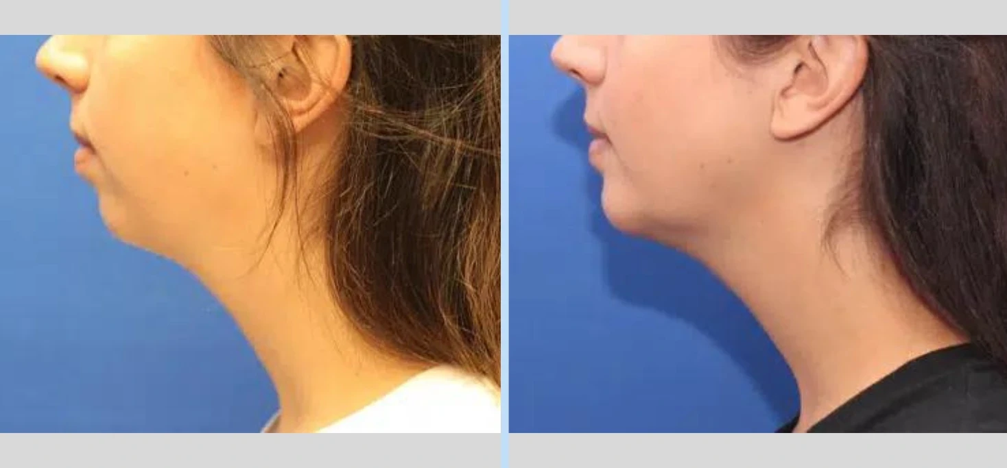 A result from Main Line Plastic Surgery- Raymond Jean MD