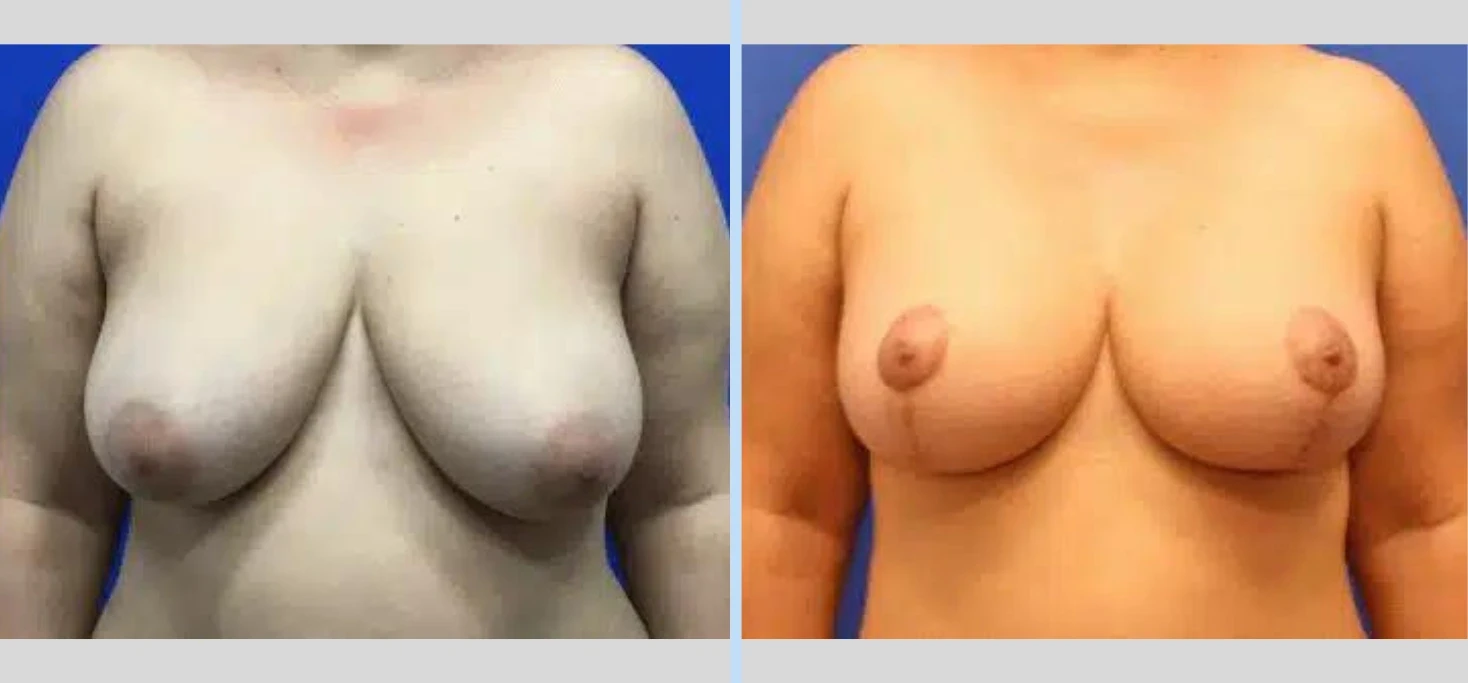 A result from Main Line Plastic Surgery- Raymond Jean MD