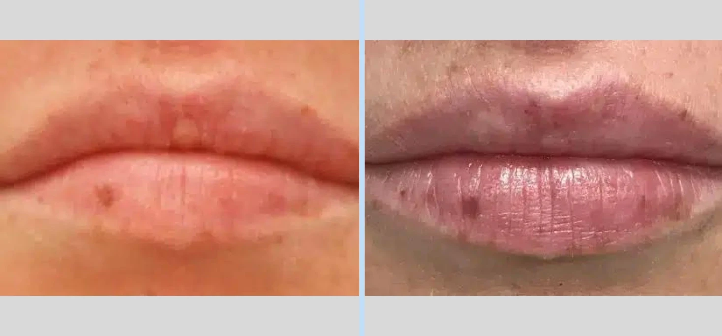 A result from Main Line Plastic Surgery- Raymond Jean MD