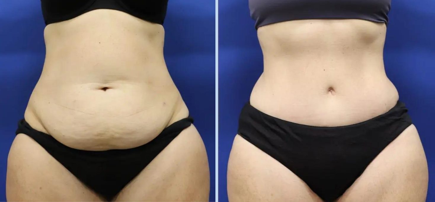 A result from Main Line Plastic Surgery- Raymond Jean MD