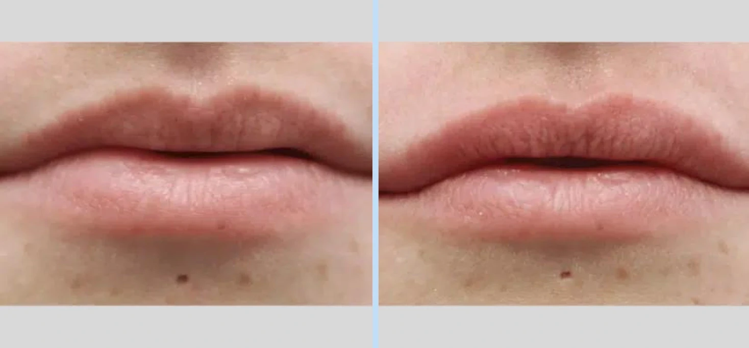 A result from Main Line Plastic Surgery- Raymond Jean MD