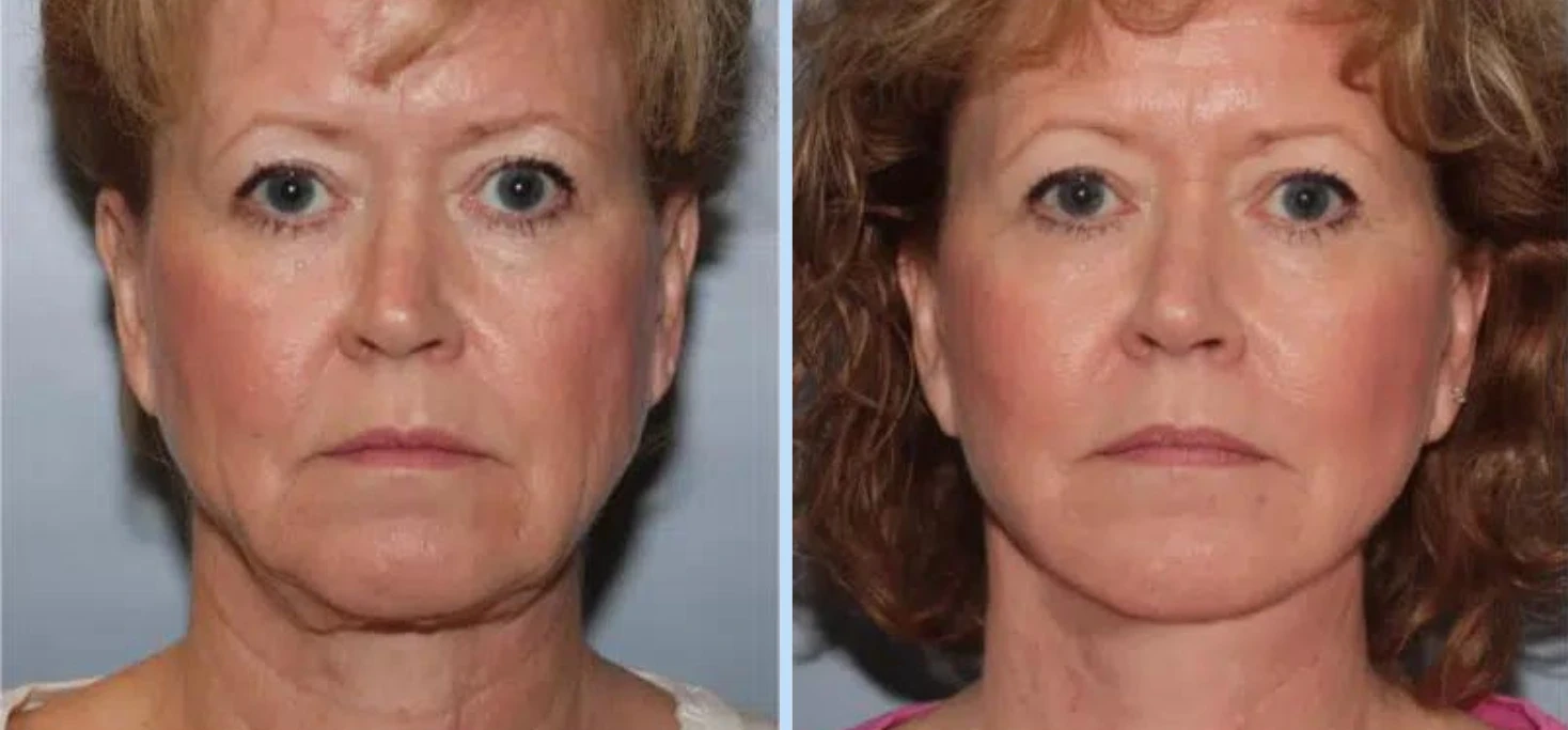 A result from Main Line Plastic Surgery- Raymond Jean MD