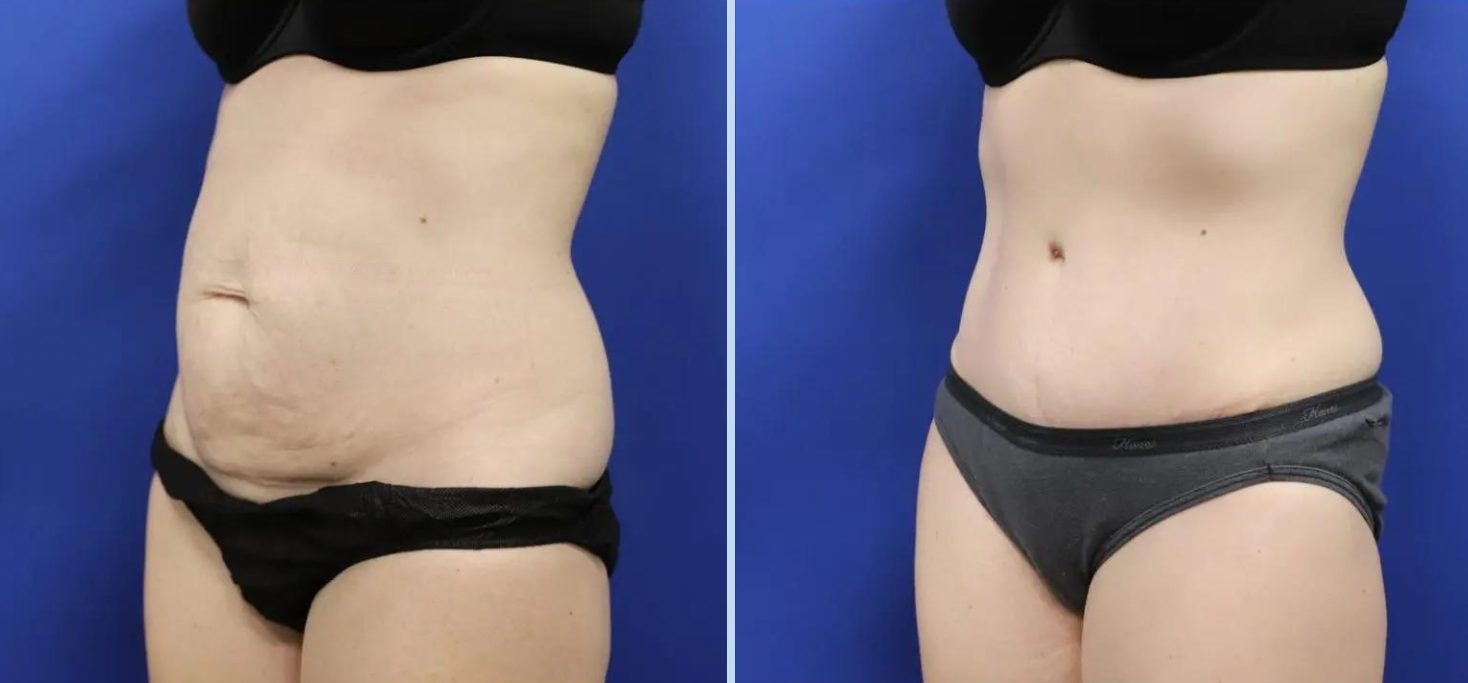 A result from Main Line Plastic Surgery- Raymond Jean MD