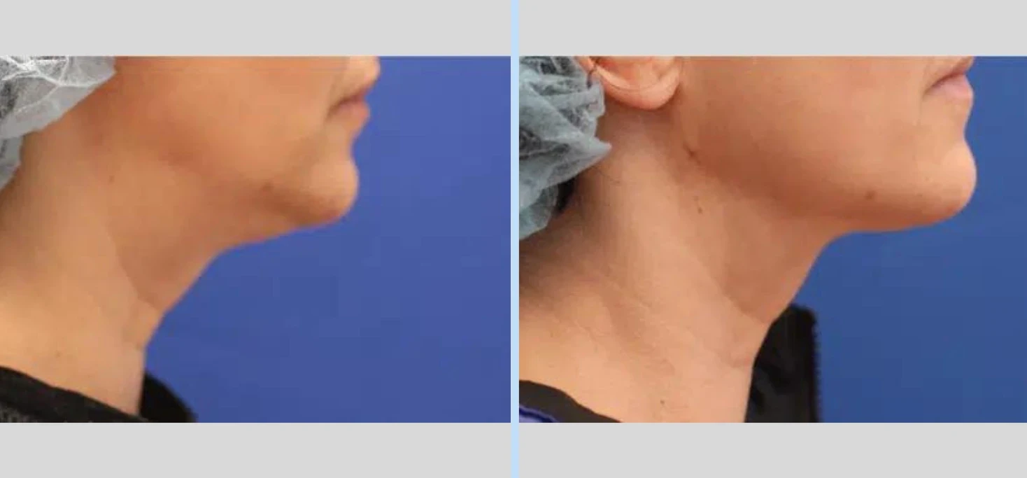A result from Main Line Plastic Surgery- Raymond Jean MD
